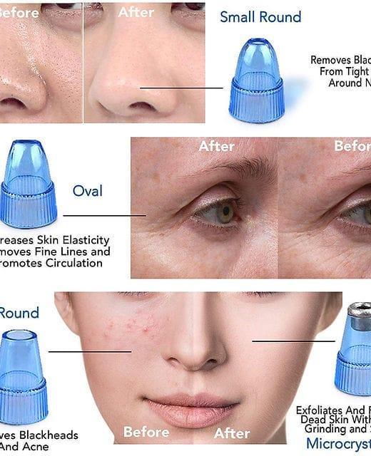 Derma Suction™ Facial Cleanser – Blackhead Remover with 4 Suction Heads | Deep Pore Cleaning Tool