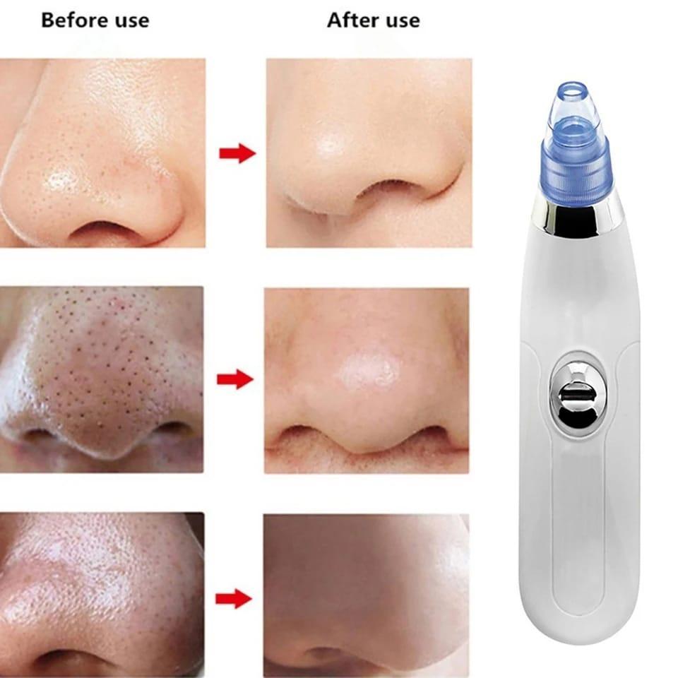 Derma Suction™ Facial Cleanser – Blackhead Remover with 4 Suction Heads | Deep Pore Cleaning Tool
