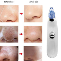 Derma Suction™ Facial Cleanser – Blackhead Remover with 4 Suction Heads | Deep Pore Cleaning Tool